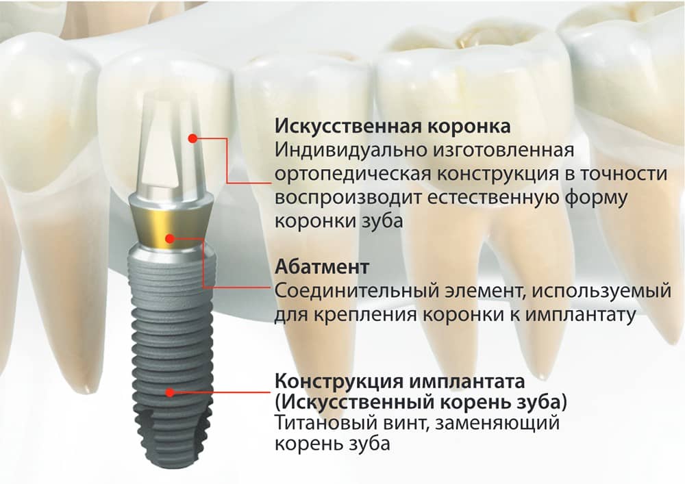 Что из себя представляет имплантат?