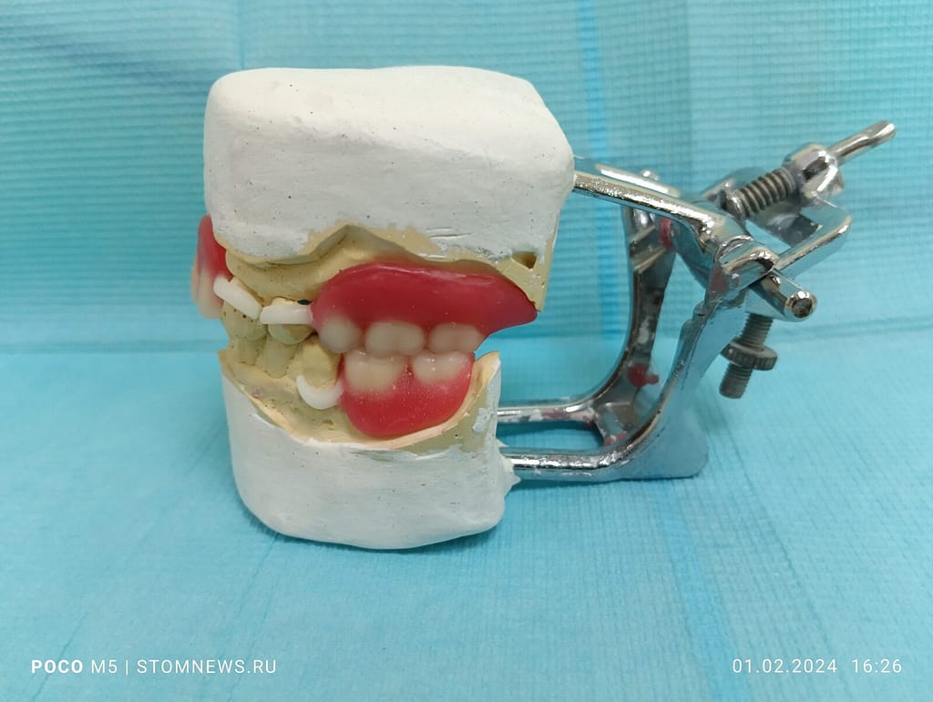 Съемный ацеталовый протез из воска вид сбоку