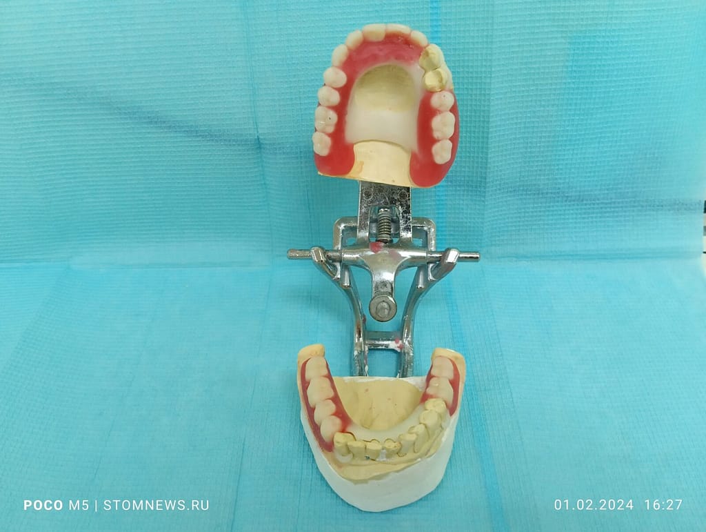 Съемный ацеталовый протез из воска вид спереди
