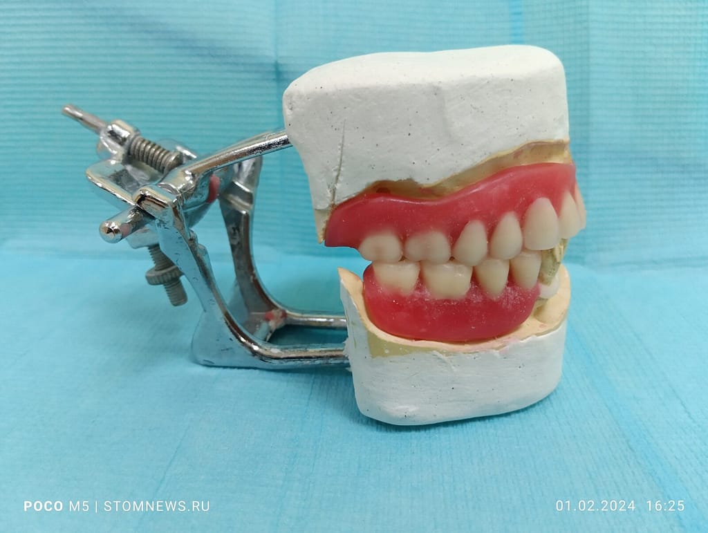 Съемный ацеталовый протез из воска вид сбоку