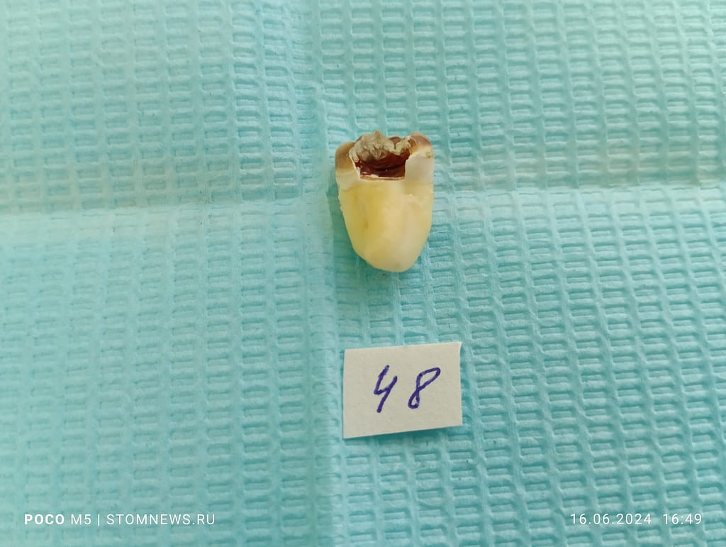 Удаленный 48 зуб мудрости с кариесом на дистальной поверхности