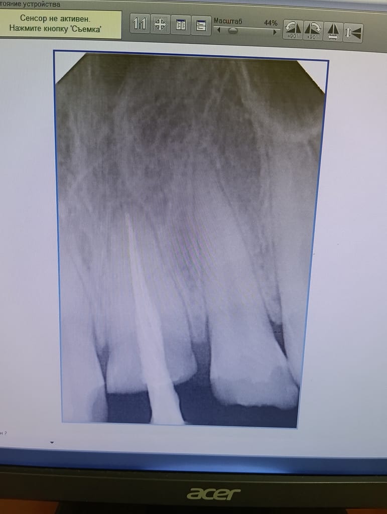 Рентген 21 зуба с запломбированным корневым каналом