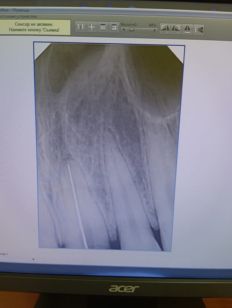 Рентгеновский снимок 21 зуба с к-файлом